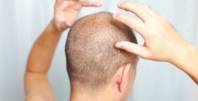 اهم طرق زراعة الشعر