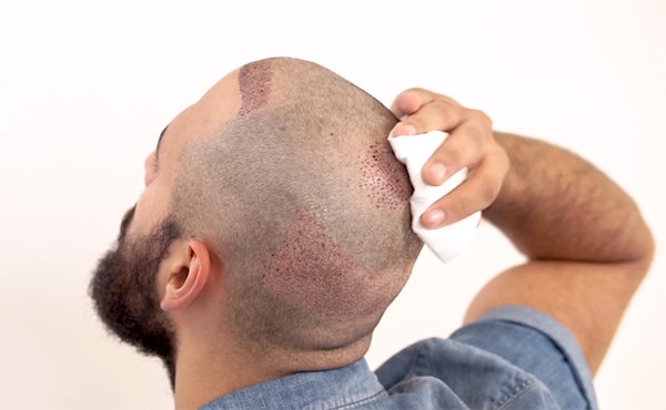 اهم طرق زراعة الشعر