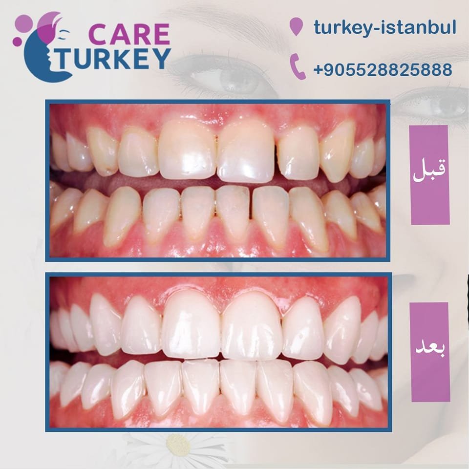 تلبيس الأسنان Dental Crowns 