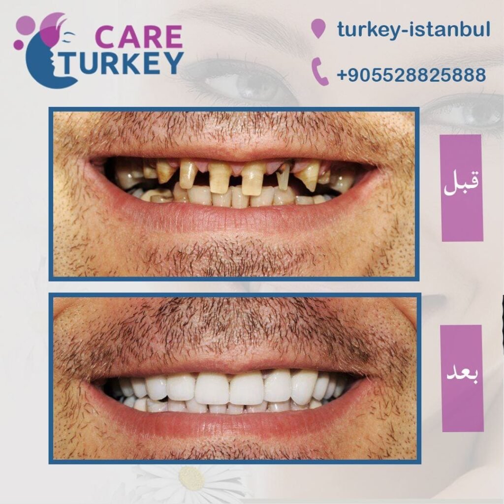 تلبيس الأسنان Dental Crowns 