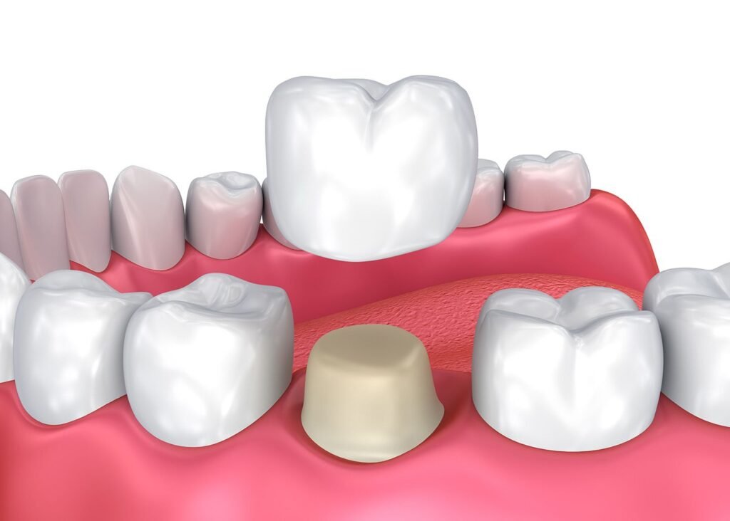 تلبيس الأسنان Dental Crowns 