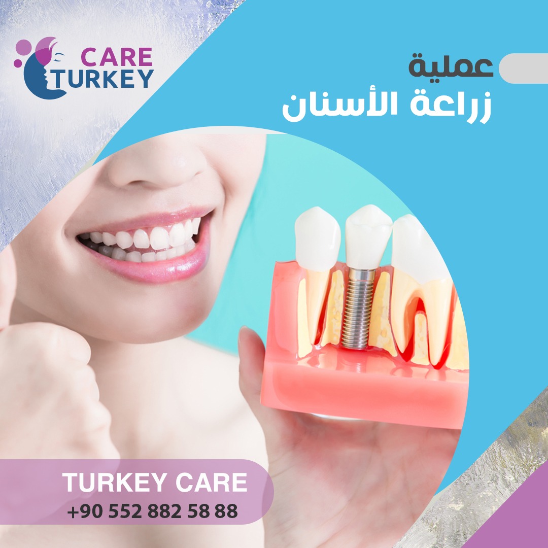 زراعة الاسنان في تركيا