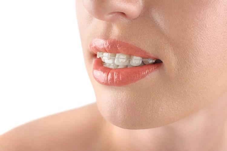 علاج تفرق الأسنان بالتقويم - سوء-اصطفاف-الاسنان