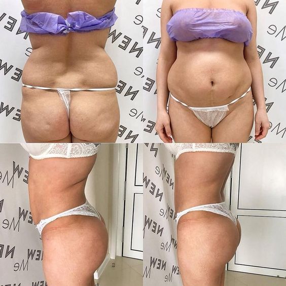 Liposuction and body sculpting