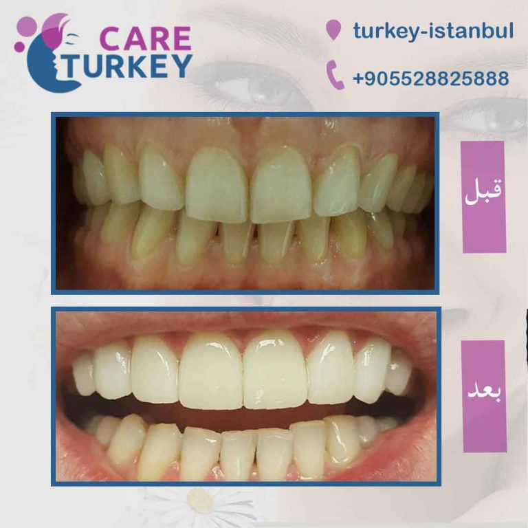 تجميل الاسنان في تركيا