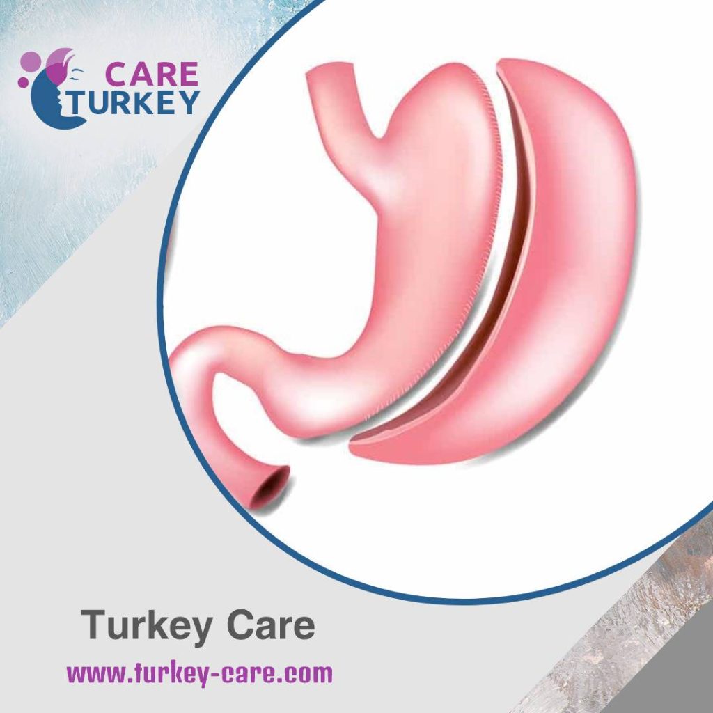 توركي كير - علاج السمنة في اسطنبول
