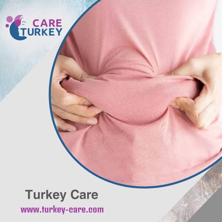 السمنة عند النساء - عملية شفط الدهون في تركيا