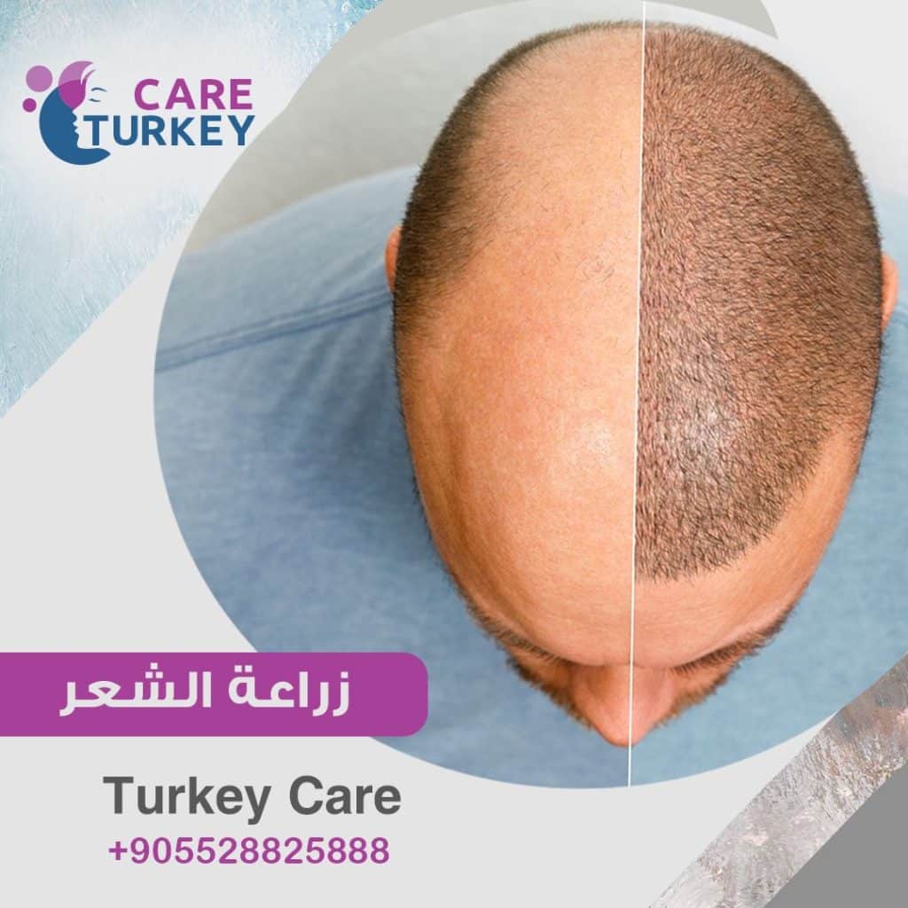 تكلفة زراعة الشعر في تركيا