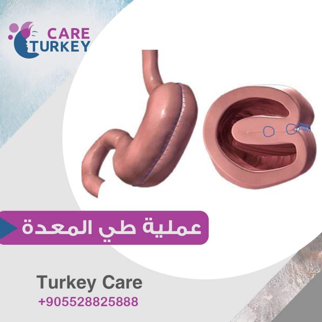 عمليات علاج السمنة في تركيا - عملية طي المعدة