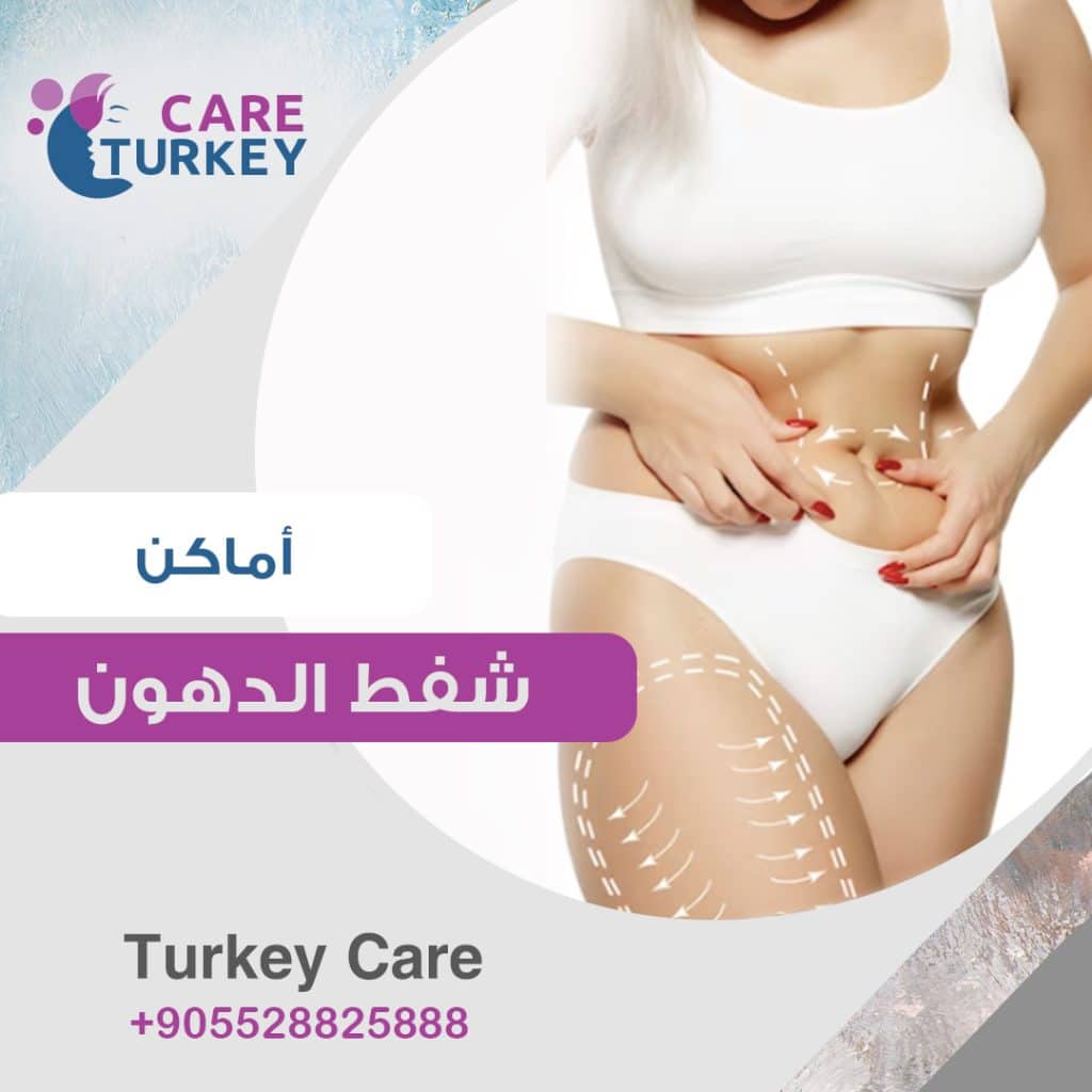 عمليات علاج السمنة في تركيا - شفط الدهون