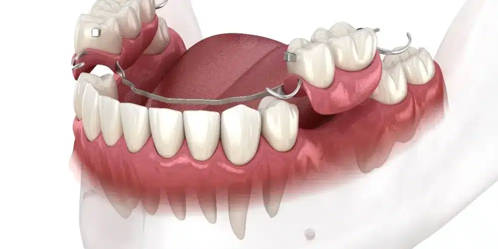 علاج تفرق الاسنان بدون تقويم