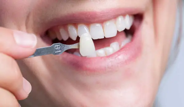 علاج تفرق الاسنان بدون تقويم
