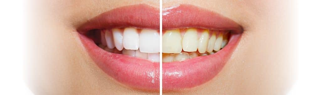اسباب اصفرار الاسنان وحلولها