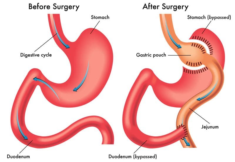 الهدف من عملية تحويل مسار المعدة Gastric Bypass