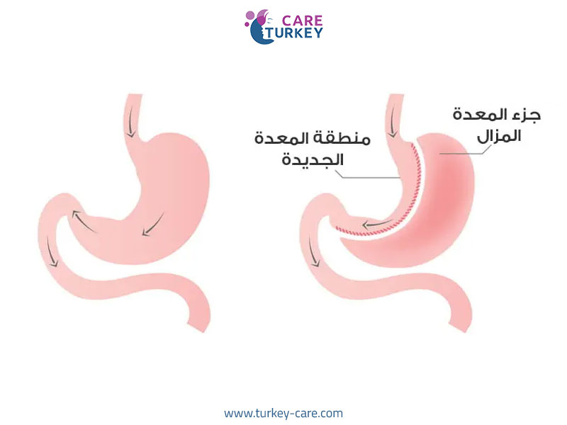 العمر المناسب لتكميم المعدة-