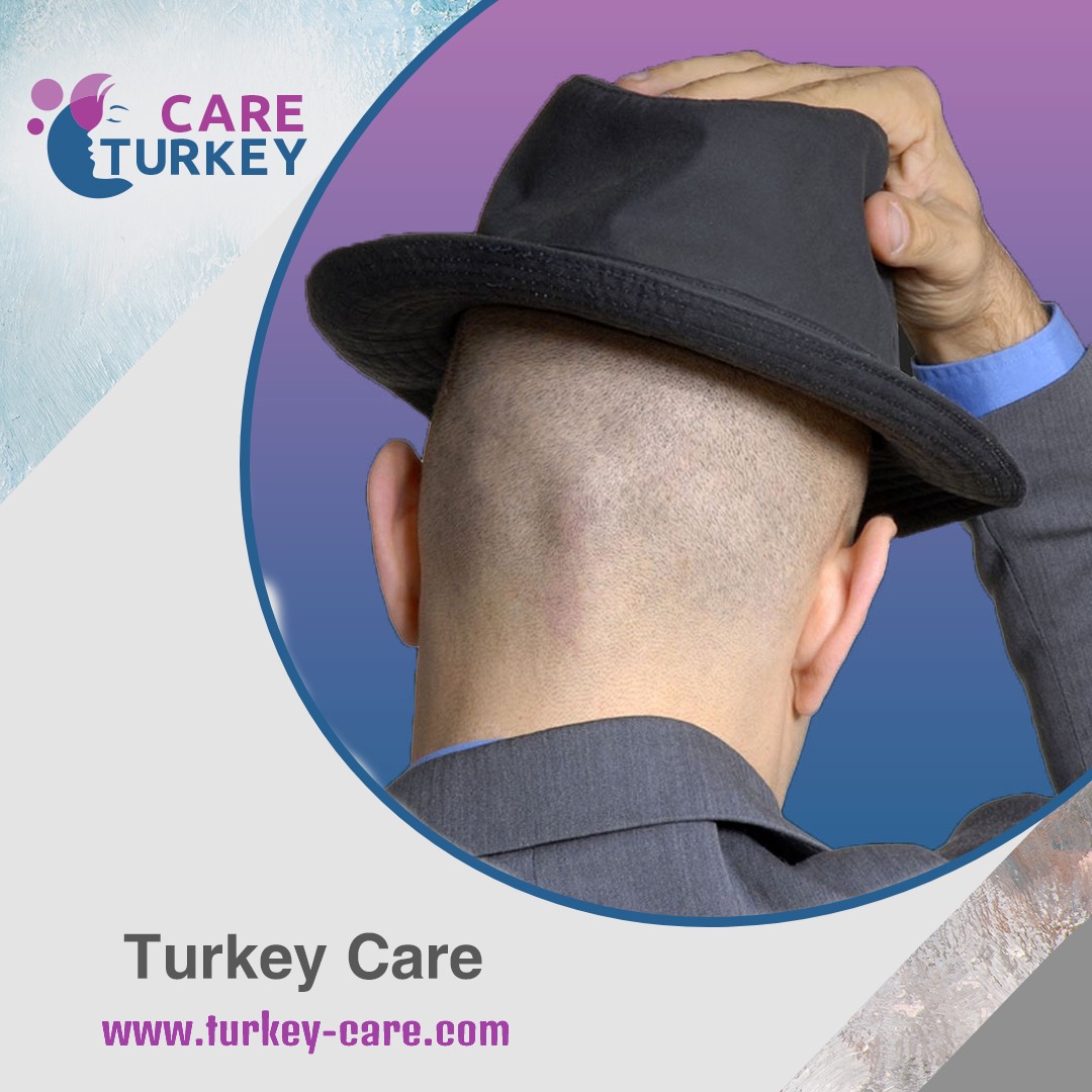 لبس القبعة بعد زراعة الشعر-رجل يضع قبعة بعذ عملية زراعة الشعر