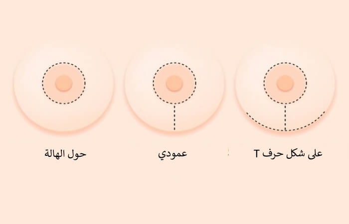 ندوب شد الثدي