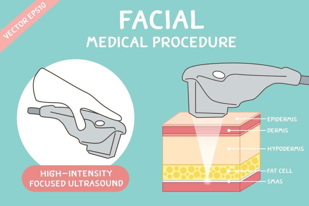 تقنية الـHIFU (High Intensity Focused Ultrasound)