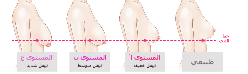 درجة ترهل الثدي
