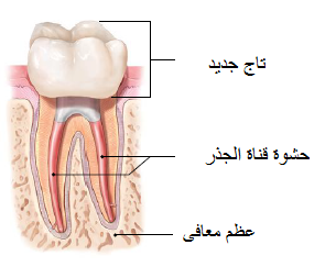 تلبيس الأسنان قبل وبعد-شكل التلبيسة