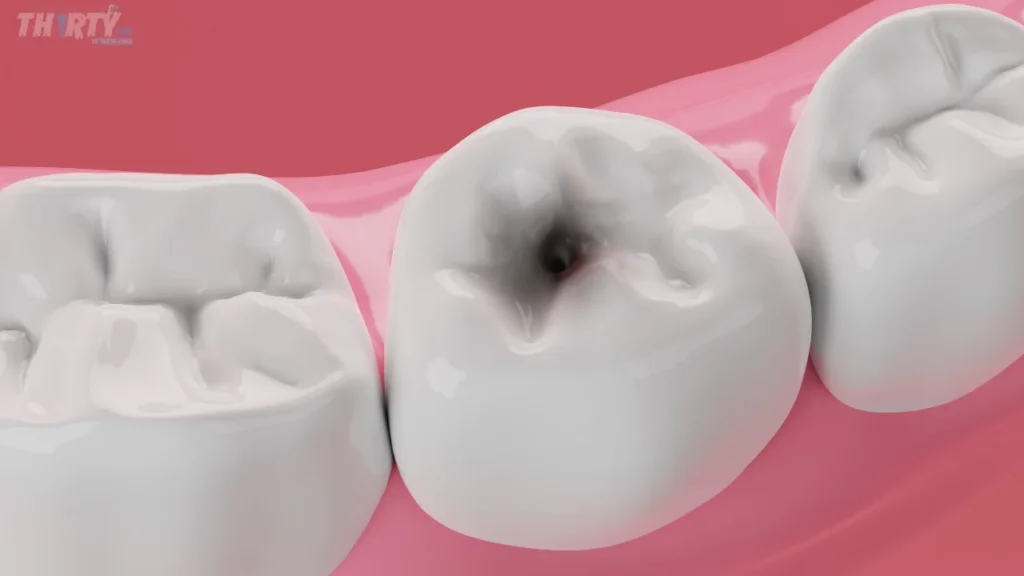 تسوس الاسنان الداعمة للجسر