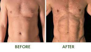 4D High Definition Liposuction