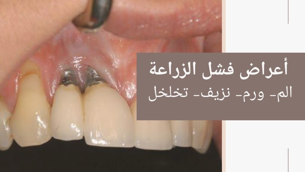 اعراض فشل الزراعة