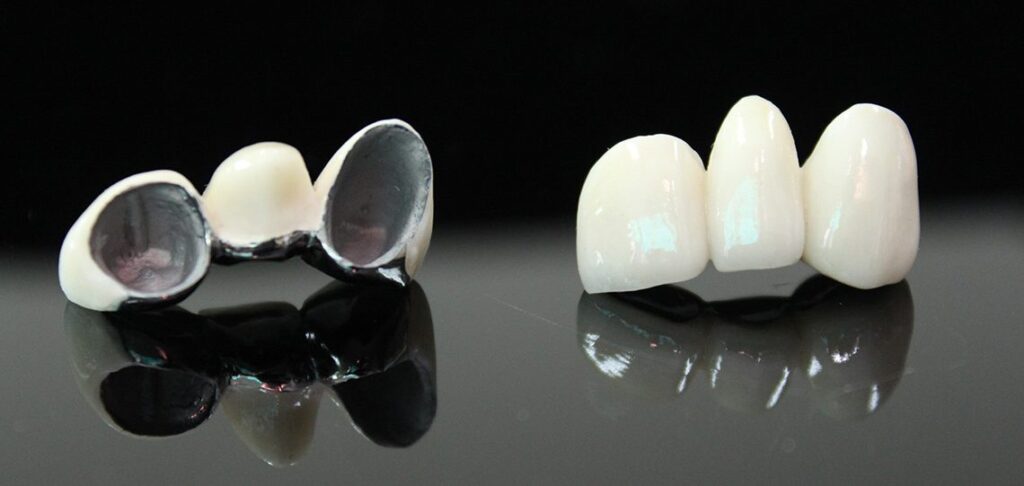 PFM: Porcelain Fused to Metal