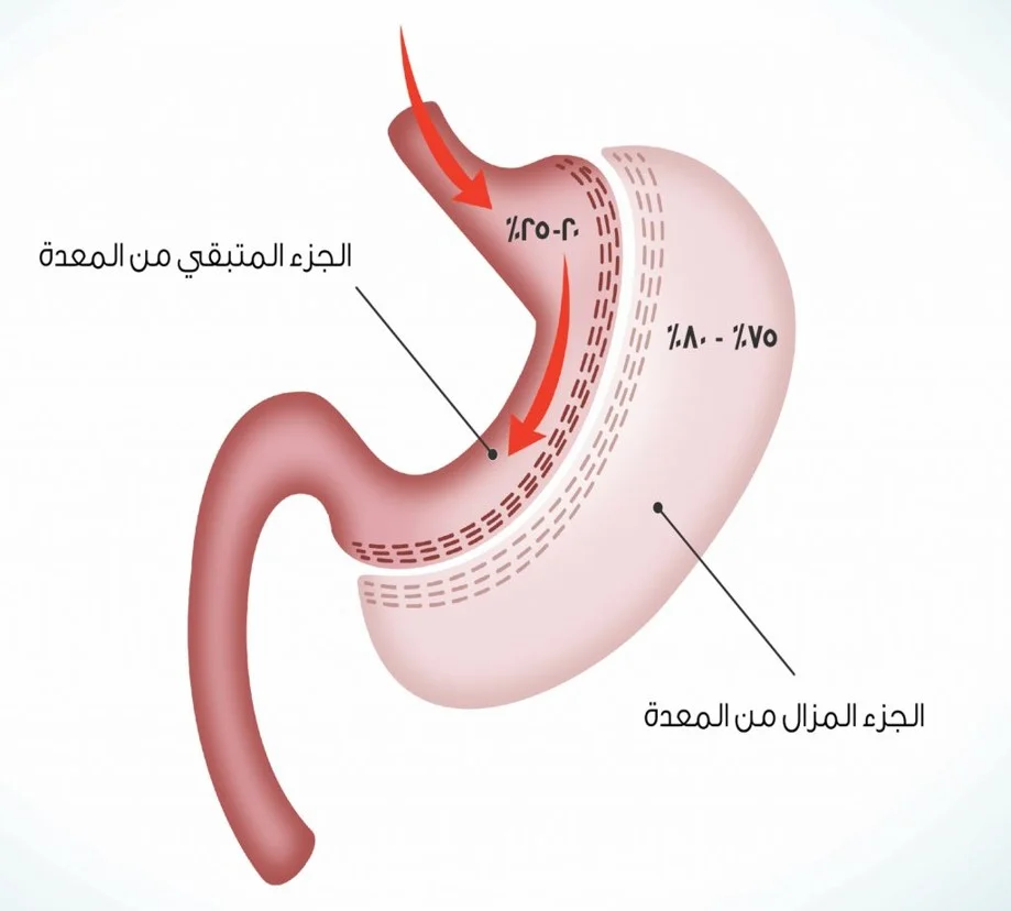 رسم تخطيطي لعملية تكميم المعدة يبرز تقليل حجم المعدة وتأثير ذلك على بطانة المعدة