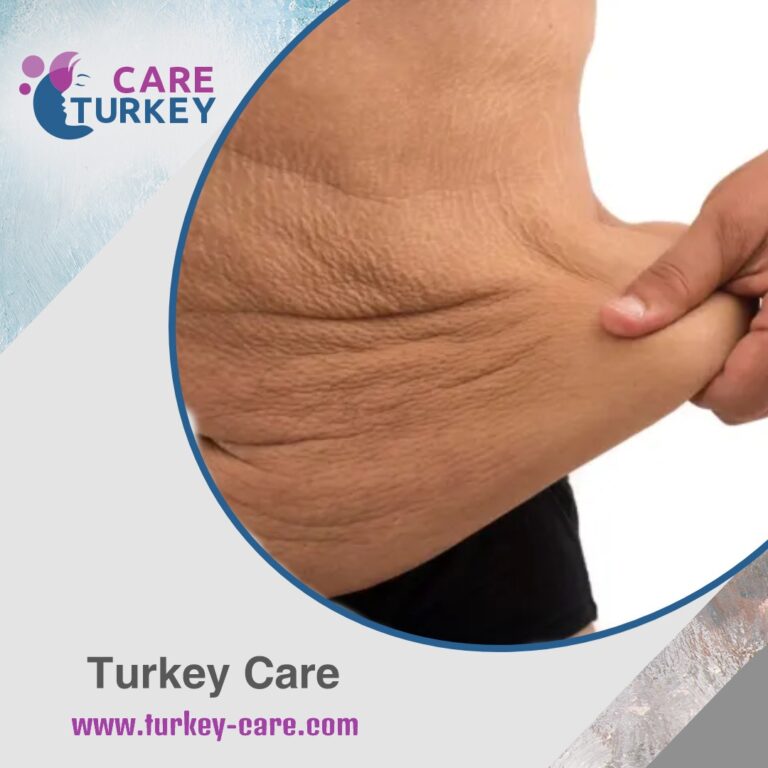 شكل البطن بعد عملية التكميم