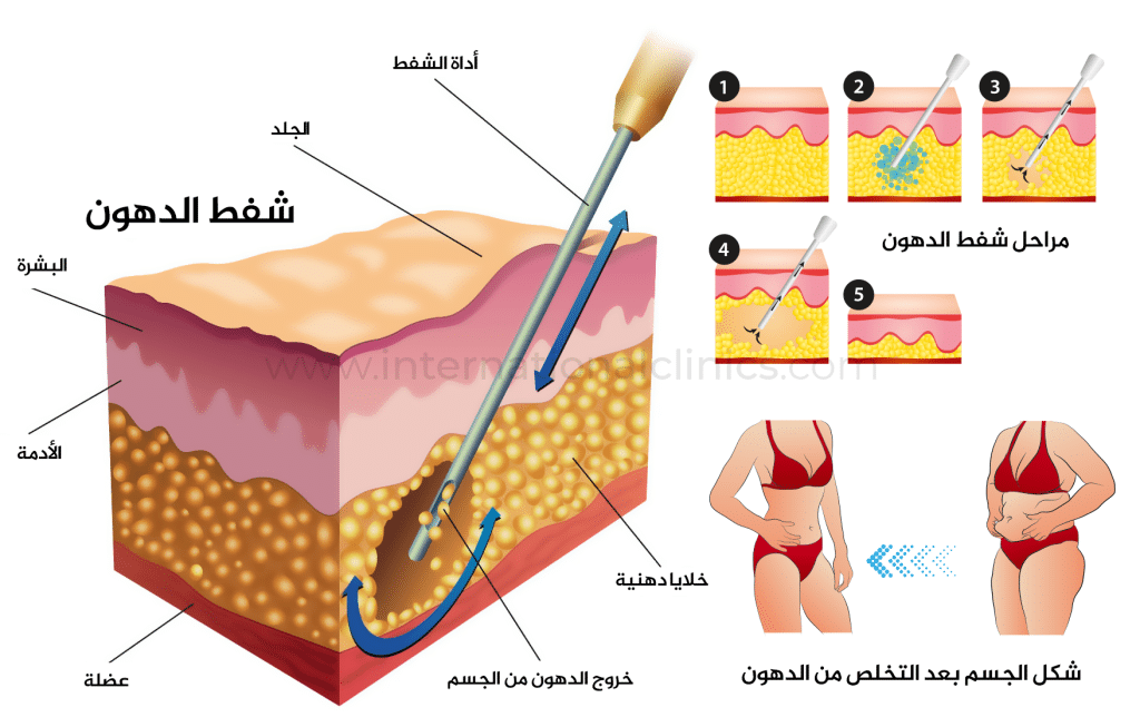 رسم توضيحي أو مخطط بسيط يُظهر أنابيب شفط الدهون (القنية) تحت الجلد أثناء العملية، مع إبراز المناطق التي يتم شفط الدهون منها.