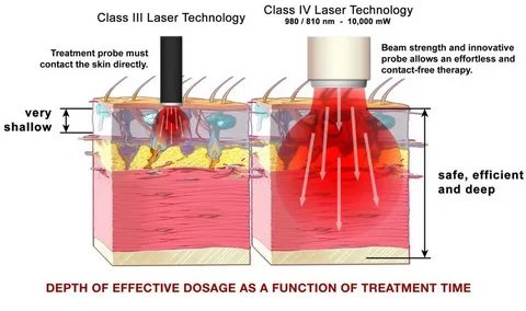 الليزر البارد (Low-Level Laser Therapy – LLLT)