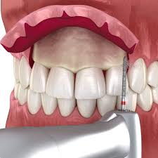 جراحة علاج الابتسامة اللثوية