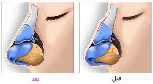 بروز بسيط في عظمة الأنف