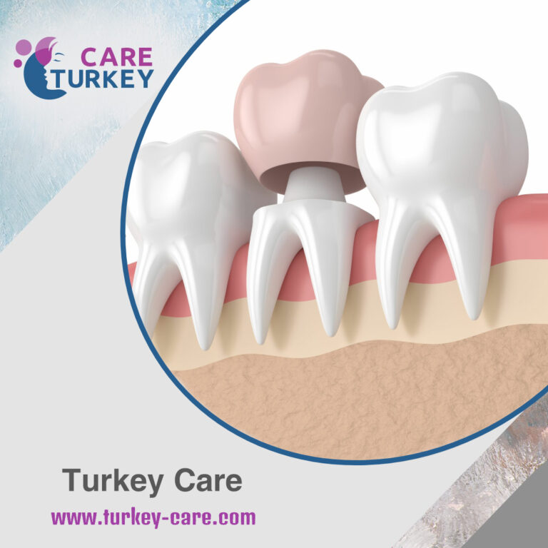 كم تدوم تيجان الأسنان