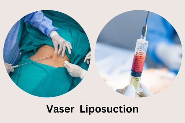Vaser Liposuction
