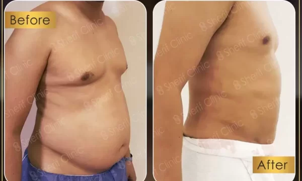 كم كيلو ينزل بعد عملية شفط الدهون-صورة قبل وبعد لشخص أجرى شفط الدهون مع اختلاف واضح في تناسق الجسم، مع ظهور بعض التورم في صورة "قبل" وعدم وضوحه في صورة "بعد