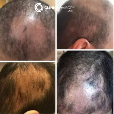 مراحل تساقط الشعر بعد الزراعة