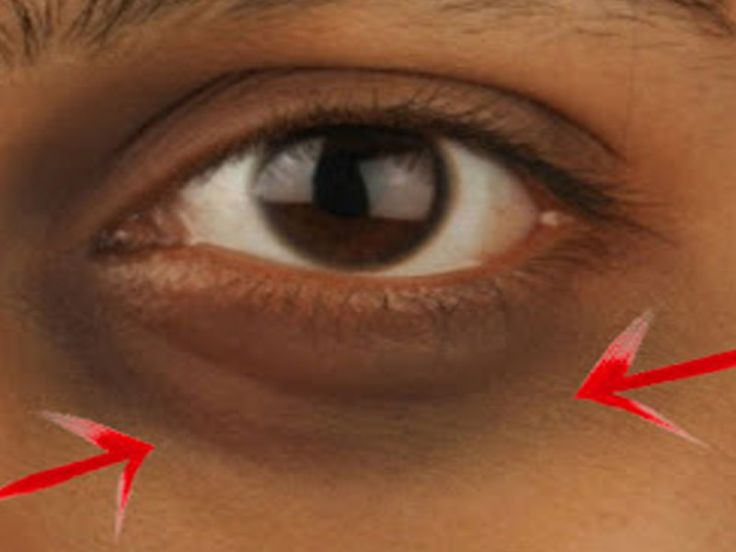 فيلر تحت العين-الهالات السوداء