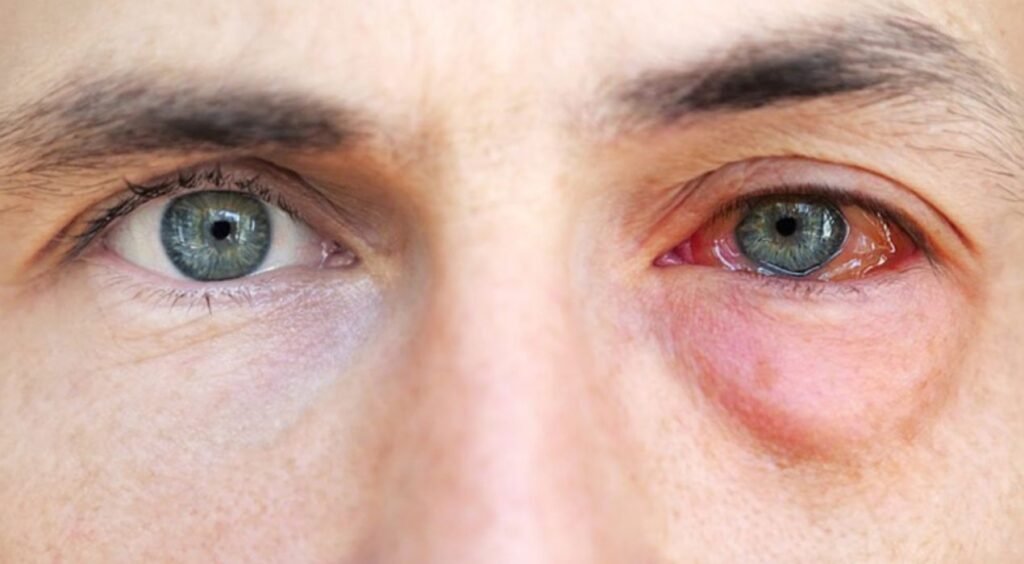 العدوى أو الالتهاب في المنطقة حول العين