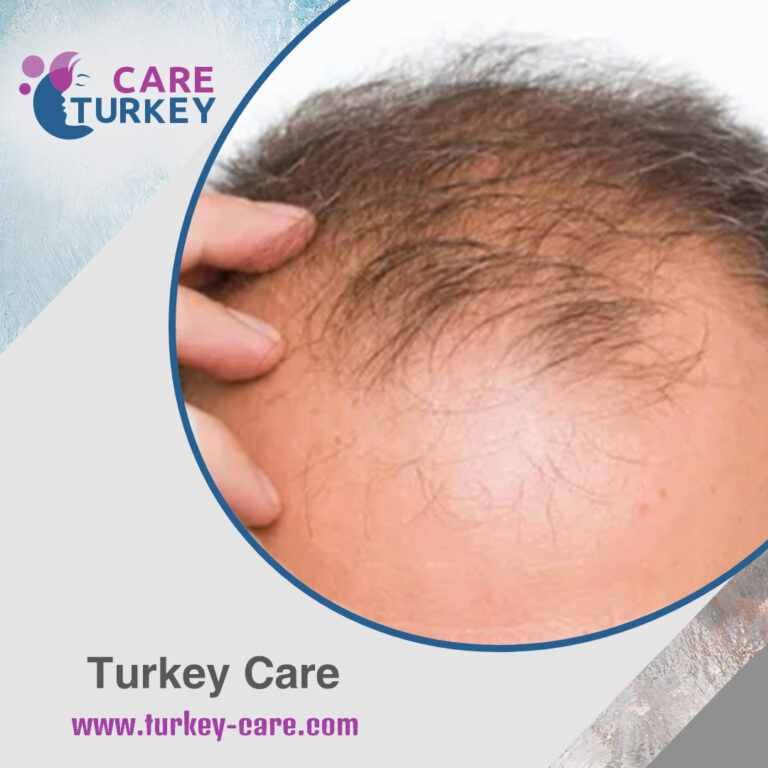 تساقط الصدمة بعد زراعة الشعر