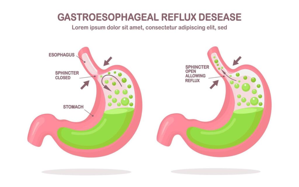 ارتجاع المريء (GERD)