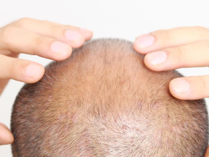  تساقط الصدمة بعد زراعة الشعر