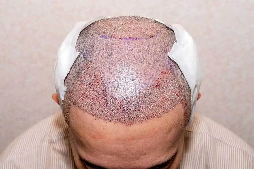 النوم بعد زراعة الشعر-صورة توضيحية لفروة رأس بعد الزراعة، تظهر مناطق مزروعة حديثًا ومظللة بضوء خفيف أثناء النوم، مع أسهم تشير إلى مناطق الضغط أو الخطر أثناء النوم