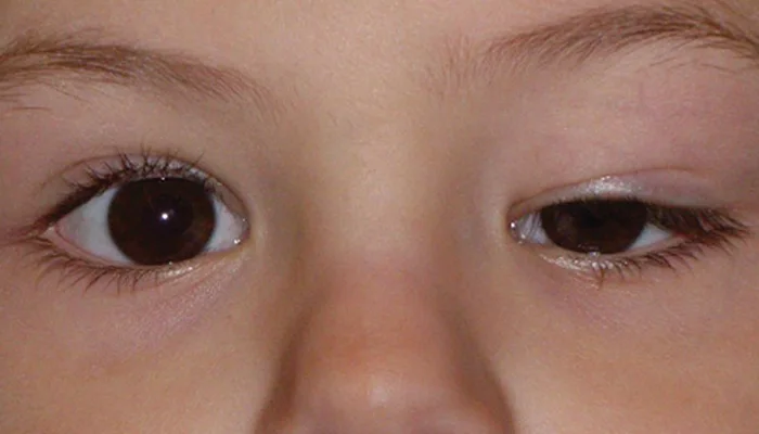 عدم تناسق الحجم بين العينين