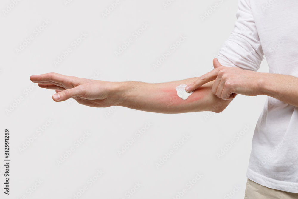 يد تضع كريم على ندبة صغيرة في البطن أو الفخذ، بجانب واقٍ شمسي واضح بعامل حماية SPF 50+.