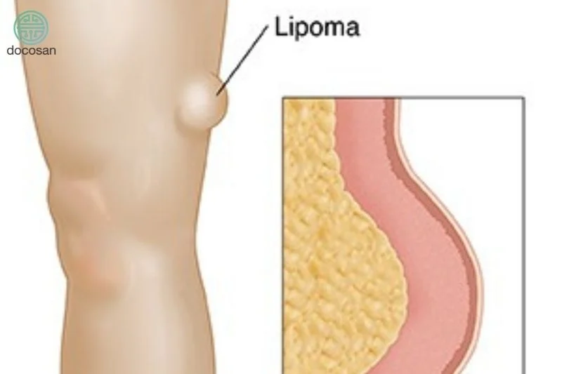 تكتلات دهنية غير منتظمة الشكل تحت الجلد.