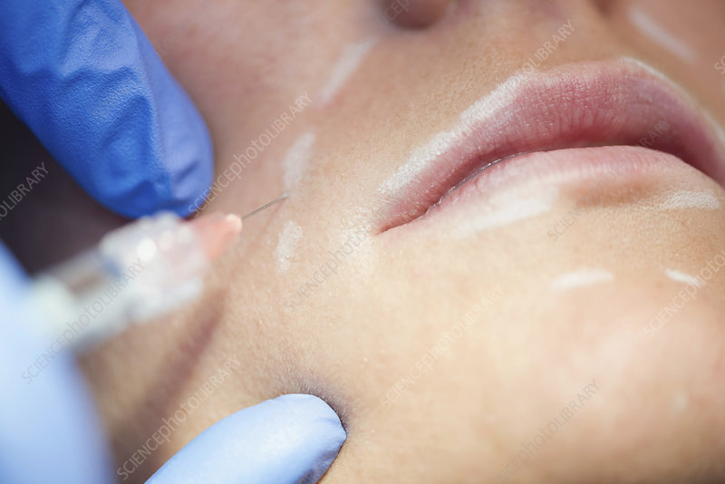 صورة توضيحية لحقن الهيالورونيداز داخل كتلة في الوجه، مع شرح نصي جانبي يوضح "إذابة الفيلر".