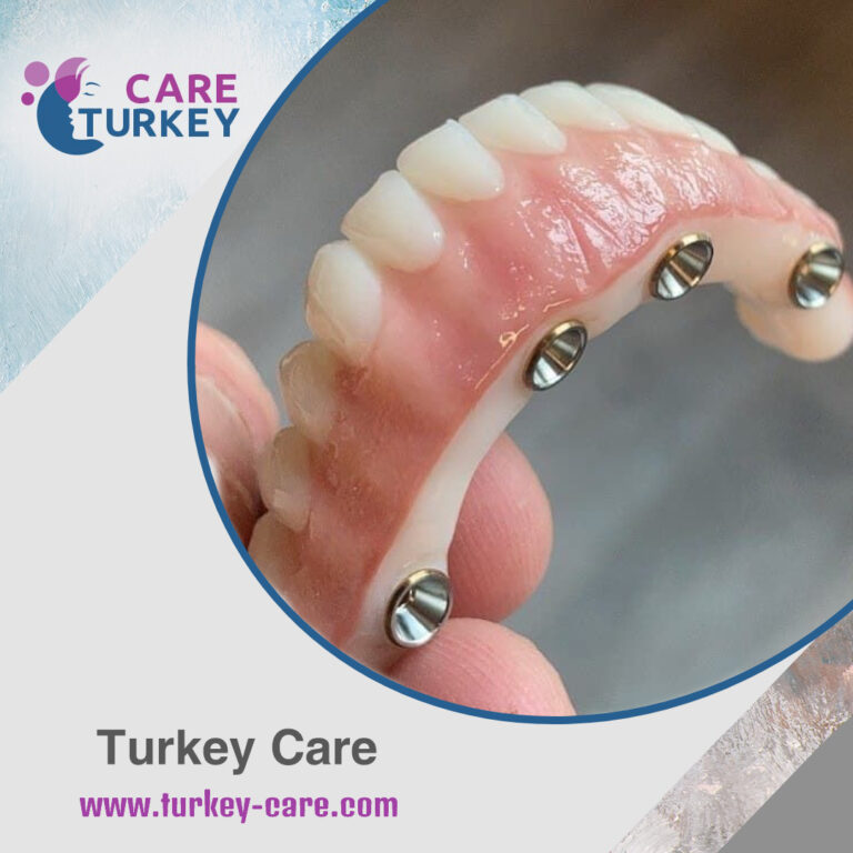 زراعة الأسنان بدون جراحة