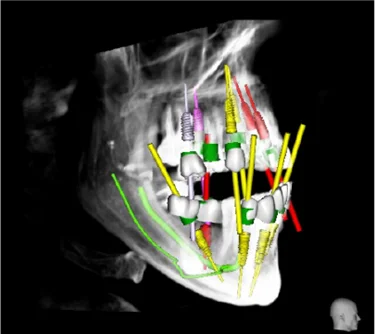 زراعة الأسنان بدون جراحة في تركيا-تقنية زراعة الأسنان بدون جراحة 3D